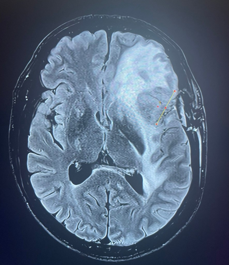 SCOLYER brain scan image