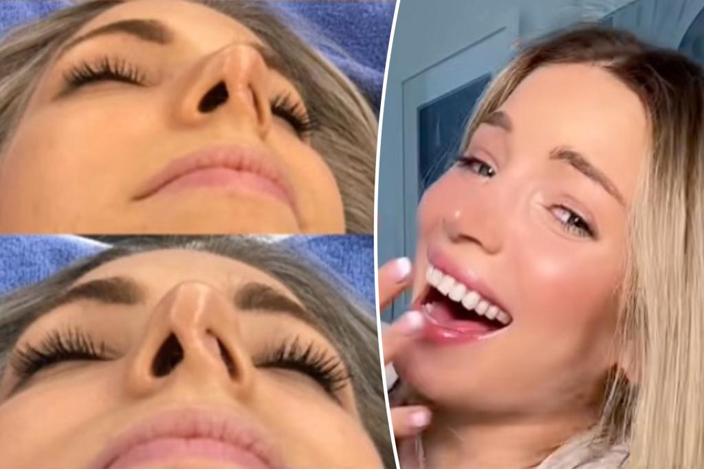I scored a 'free' nose job - then got the shock of my life that came with a priceag $ 26k