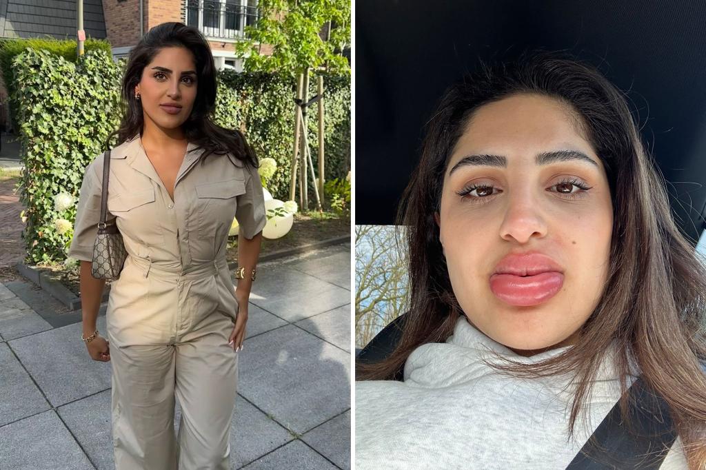 Treating the distribution of my lip filler went terribly wrong - and let me look like a bratz doll